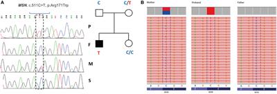 Exome Sequencing Diagnoses X-Linked Moesin-Associated Immunodeficiency in a Primary Immunodeficiency Case